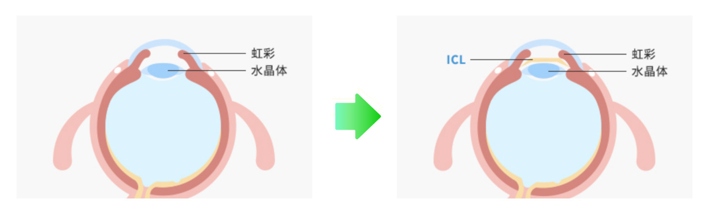 白内障手術　実績