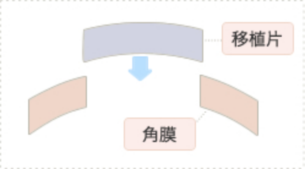 全層角膜移植（DKP）