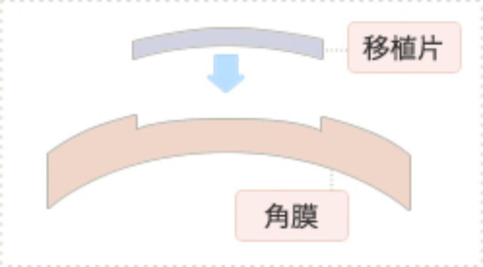 表層角膜移植