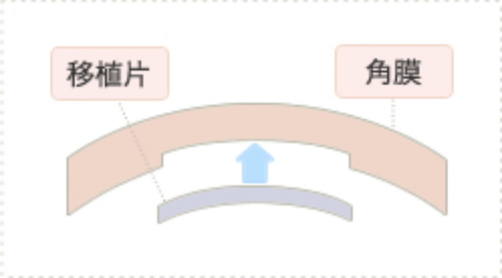 角膜内皮移植（DSAEK）