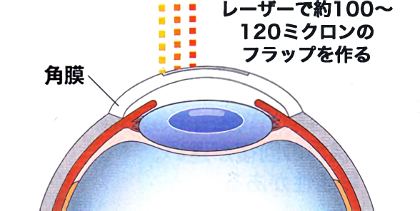 フェムトセカンドレーザー/レーシック