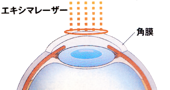 フェムトセカンドレーザー/レーシック